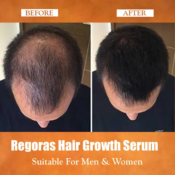 hair fall control serum