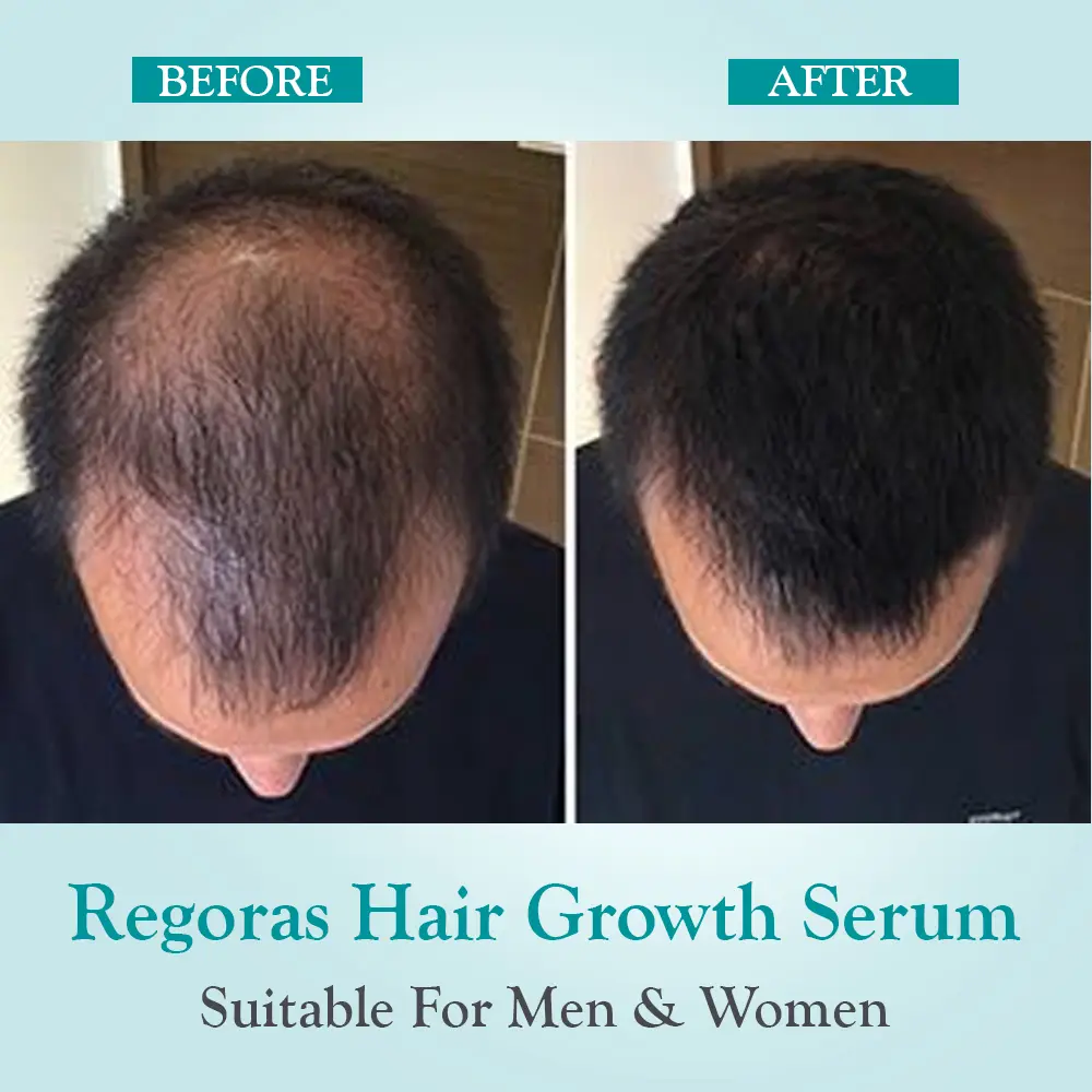 after and befor Regoras Hair Growth Serum